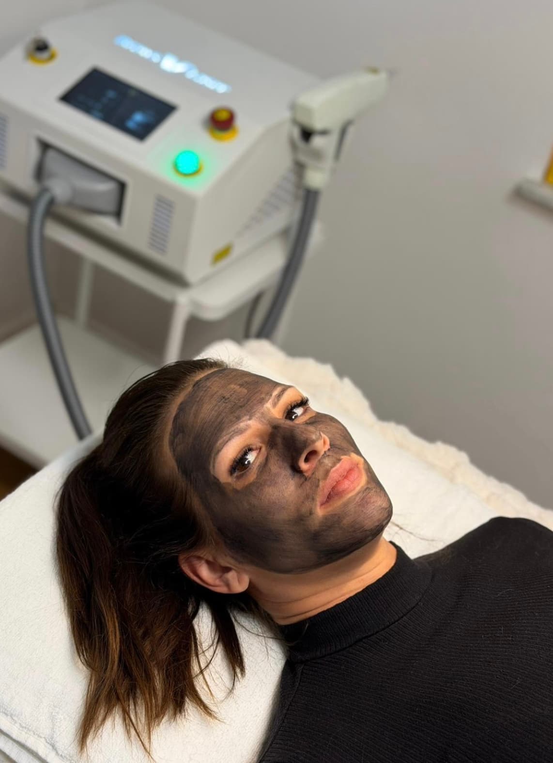 Carbon Peel tretman — rezultat