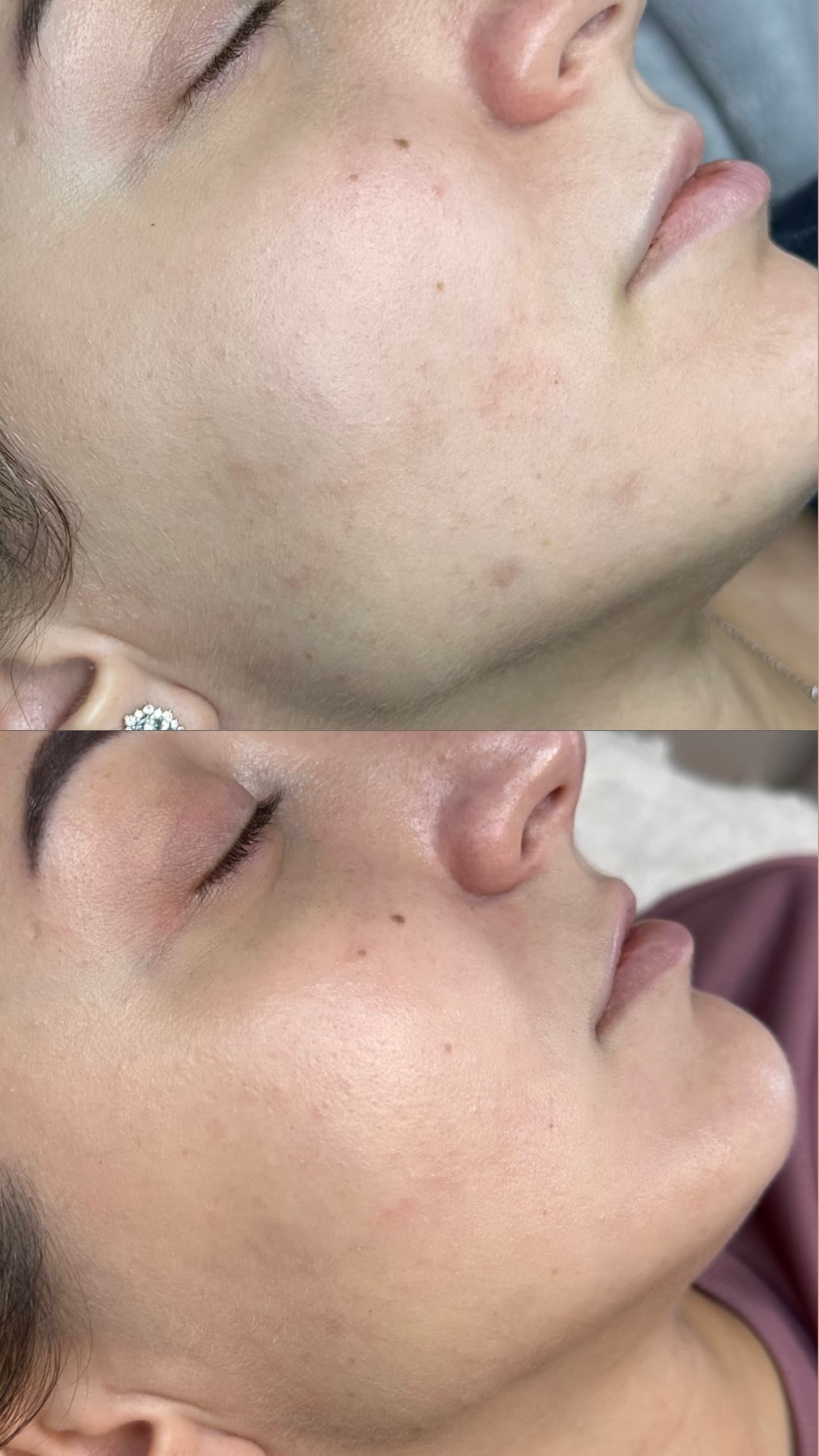 Carbon Peel tretman — sjaj kože