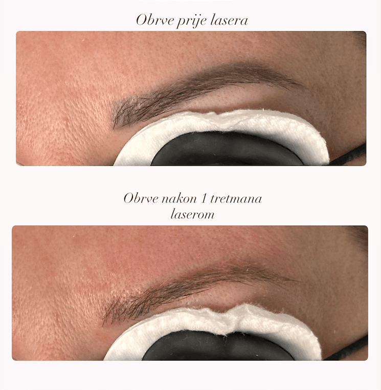 Lasersko skidanje trajne šminke — rezultat