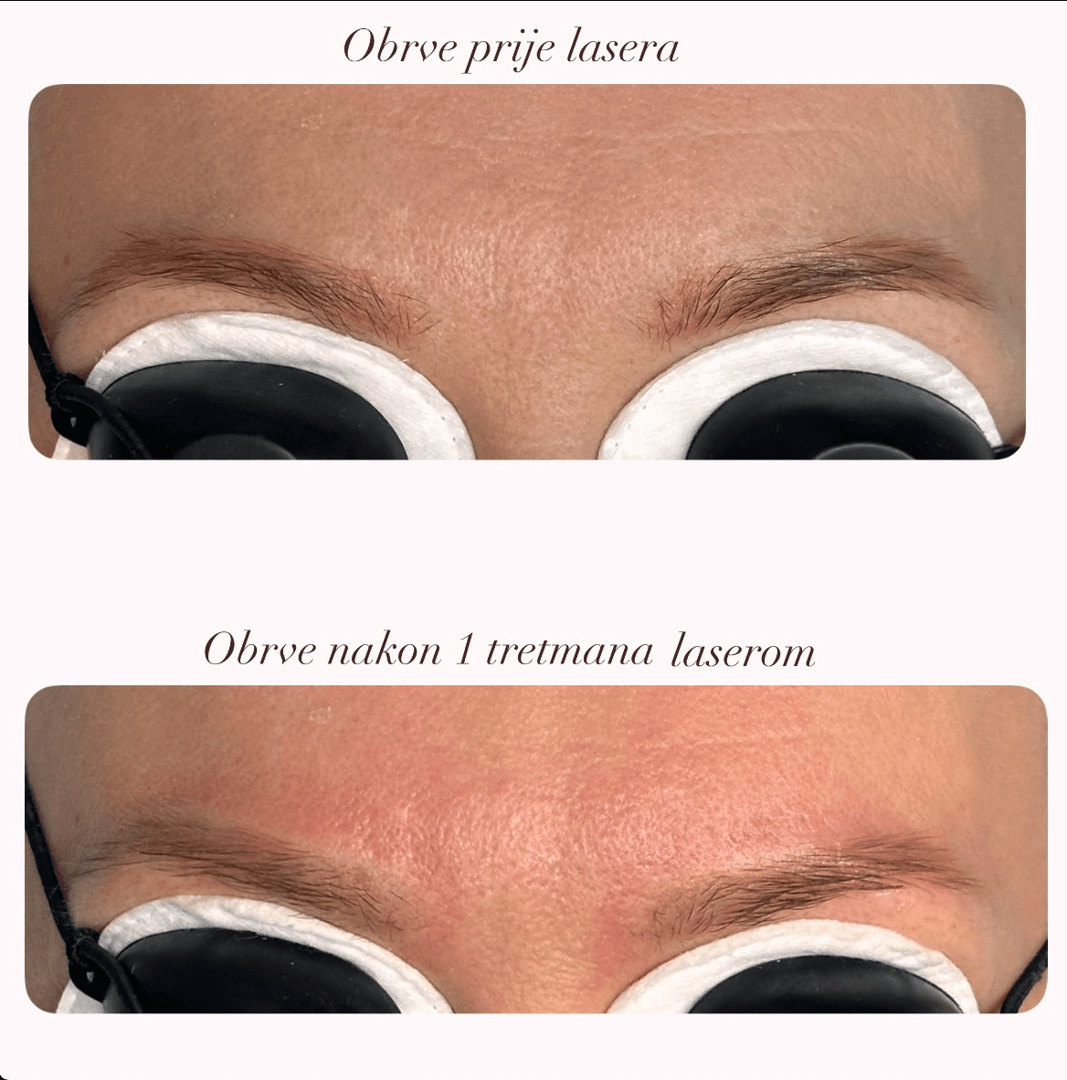 Lasersko skidanje trajne šminke — preciznost